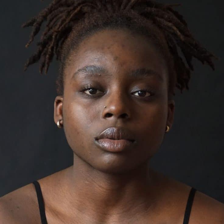 Hyperpigmentation de la peau, comprendre les taches pigmentaires en 3 étapes clés.